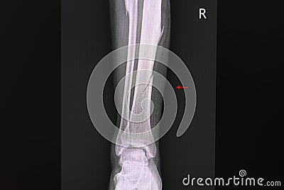 X-ray film of a patient with spiral fracture of right tibia Stock Photo