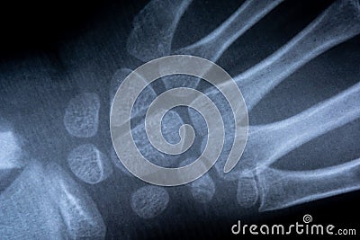 X-ray film skeleton human arm. health medical anatomy body concept Stock Photo