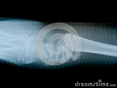 X-ray film skeleton human arm. health medical anatomy body concept Stock Photo