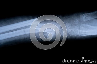 X-ray film skeleton human arm. health medical anatomy body concept Stock Photo