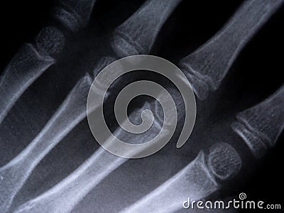 X-ray film skeleton human arm. health medical anatomy body concept Stock Photo