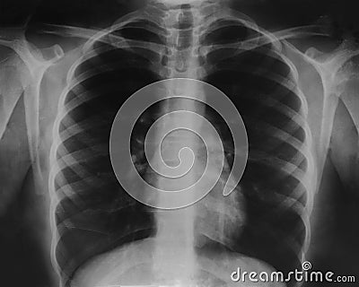 X-ray film of the teenager& x27;s thorax Stock Photo