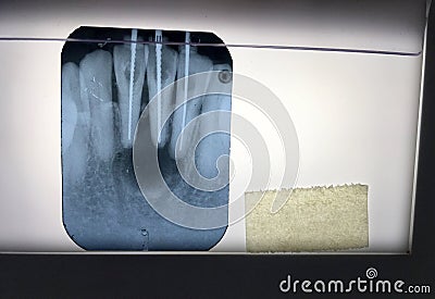 The X-ray film of teeth diagnosed in the dental clinic of Thailand Bangkok; Thailand December 1, 2018 Stock Photo