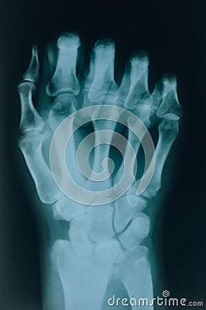 X-ray of the fist. Hand bones. Diseases and injuries of human bones Stock Photo