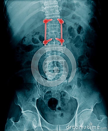 x-ray fixation lumbar Stock Photo