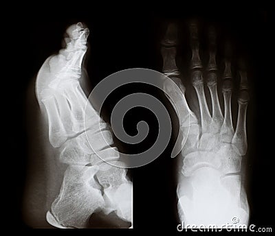 X-ray of a foot Stock Photo