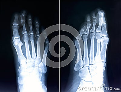 X-ray of foot fingers. Radiography with deformed toes. Hallux valg Stock Photo
