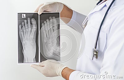 X ray of foot front view, Doctor looking chest x-ray film,Anatomy. Stock Photo