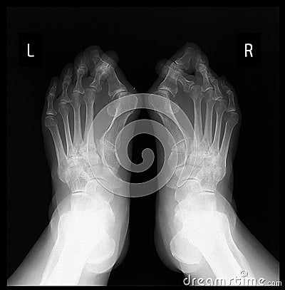 X-ray foot. Hallux valgus. Stock Photo