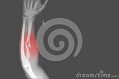 X-ray forearm AP views showing Fracture proximal Left radius and soft tissue swelling on red point ,medical image concept Stock Photo