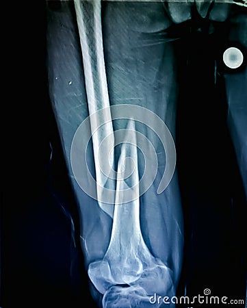 X-Ray of fracture right thigh in 50 year old man Stock Photo