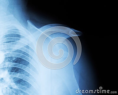 X-ray of a fractured humeral head and shoulder dislocation. Clavicle fracture. Traumatology and orthopedics., close-up Stock Photo