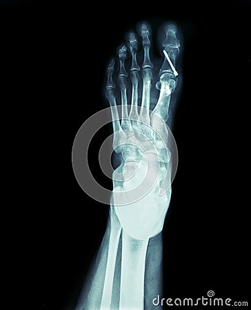 X-ray of the front foot Hallux Valgus surgery Stock Photo