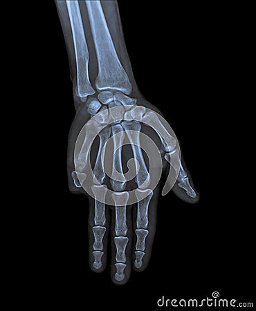 X ray of hand with amputated little finger Stock Photo