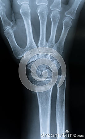 X-Ray of the hand Stock Photo