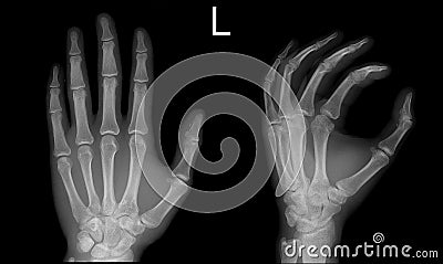 X-ray hand Frontal Oblique view normal Stock Photo