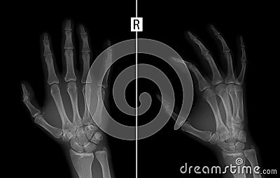 X-ray of the hand. Shows the Fracture of the base of the proximal phalanx of the second finger of the right hand. Stock Photo