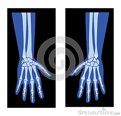X-Ray Hands with Radius, Ulna Skeleton Human body, Bones adult people roentgen front view. 3D realistic flat blue color Vector Illustration