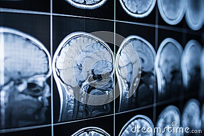 X-ray of the head and brain of a person Stock Photo