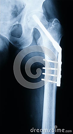 X-ray of a Hip Stock Photo