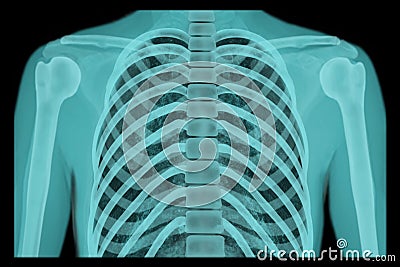 X-ray of the human chest, the concept of preventive examination, treatment of injuries, lung diseases Stock Photo