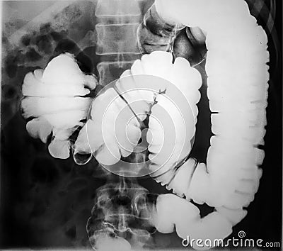 X-ray of the human intestine Stock Photo