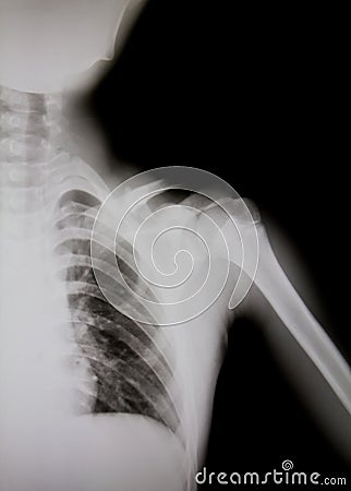 X-ray of human shoulder (broken shoulder) Stock Photo