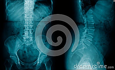 x-ray human spine AP and lateral view Stock Photo