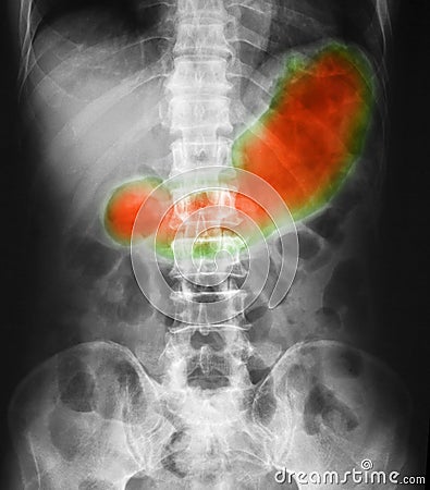 X-ray image of abdomen supine position, show gastric juice Stock Photo