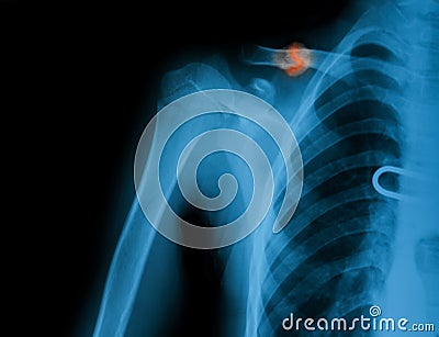 X-ray image of broken clavicle. Stock Photo