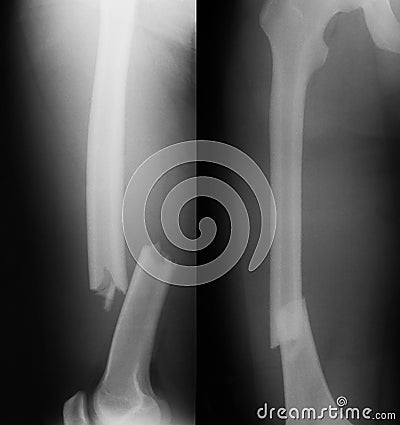 X-ray image of broken femur. Stock Photo