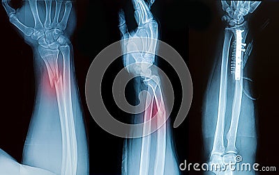 X-ray image of broken forearm bone Stock Photo