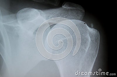 X-Ray image of calcified shoulder Tendinosis calcarea Stock Photo