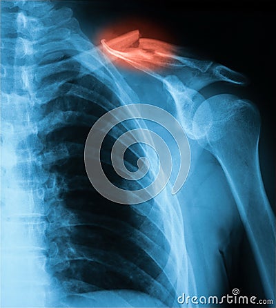 X-ray image of clavicle, AP view. Stock Photo