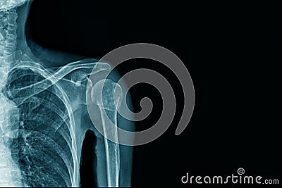 X-ray image clavicle fracture Stock Photo