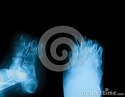 X-ray image of diabetic foot amputation. Stock Photo