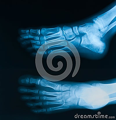 X-Ray image of foot, AP and oblique view. Stock Photo