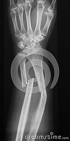 X-ray image of forearm, AP view (Antero-posterior view, show fracture of ulna and radius Stock Photo