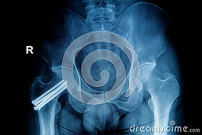 X-ray image of fracture leg ( head of femur ) Stock Photo