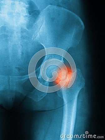 X-ray image of hip joint antero posterior view. Stock Photo
