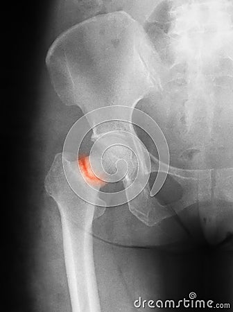 X-ray image of hip joint, antero-posterior view, Stock Photo