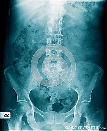 X-ray image of human abdomen, picture of human spine and pelvic bone show degenerative change of spine Stock Photo