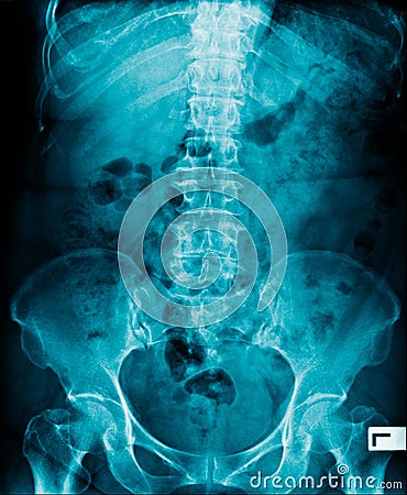 X-ray image of human abdomen Stock Photo