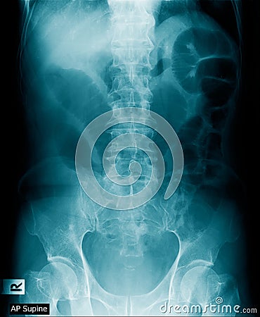 X-ray image of human abdomen, picture of human spine Stock Photo