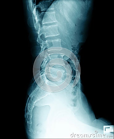 X-ray image of human abdomen, picture of human spine Stock Photo