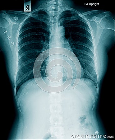 X-ray image of human abdomen, picture of human spine Stock Photo