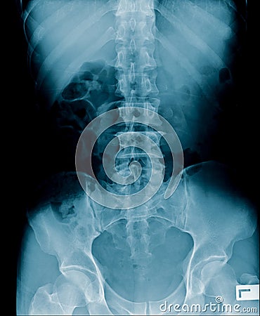 X-ray image of human abdomen, picture of human spine Stock Photo