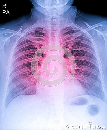 X-Ray Image Of Human Chest for a medical diagnosis, shows pain area with red. Thorax x-ray for lungs examination, PA up right Stock Photo