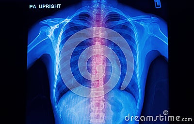 X-ray image of human spinal column Stock Photo