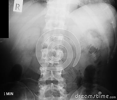 X-ray image of IVP, supine view. Stock Photo